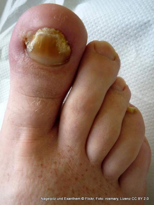 Bild zu Die Gefahr lauert im Freibad: Sind Ihre Fe vor Nagelpilz sicher?
