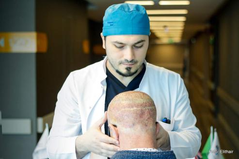 Bild zu Haartransplantations-Methoden im berblick