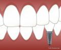 Zahnersatz durch Implantate  das sollte man wissen