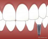 Bild zu Zahnersatz durch Implantate  das sollte man wissen