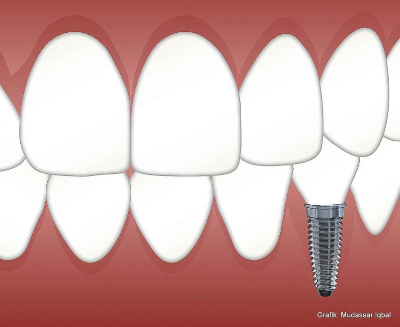 Zahnersatz durch Implantate – das sollte man wissen